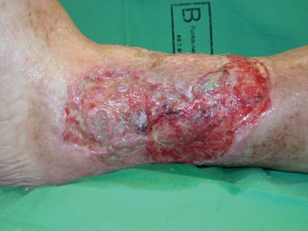 Alginol Wundverbände Bild li Ulcus cruris mixtum mit kritischer Kolonisation