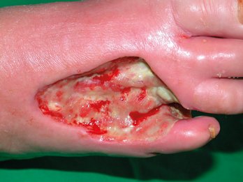 Alginol Wundverbände Bild re DFS nach operativer Entfernung der 4